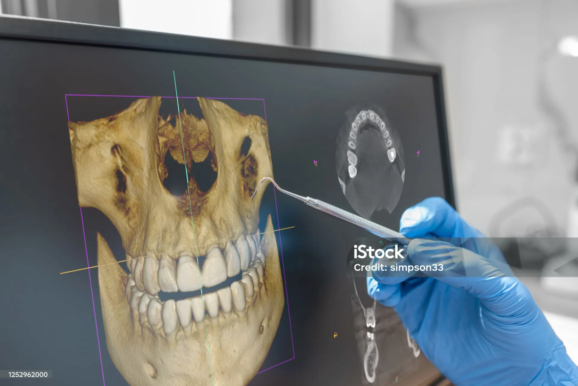 Tomografia 3D